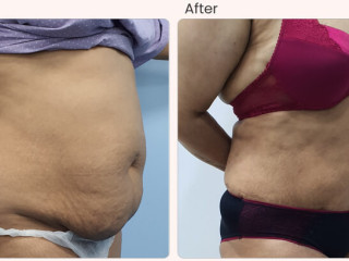 Best Liposuction Surgery in Delhi India