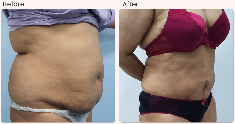 best-liposuction-surgery-in-delhi-india-big-0