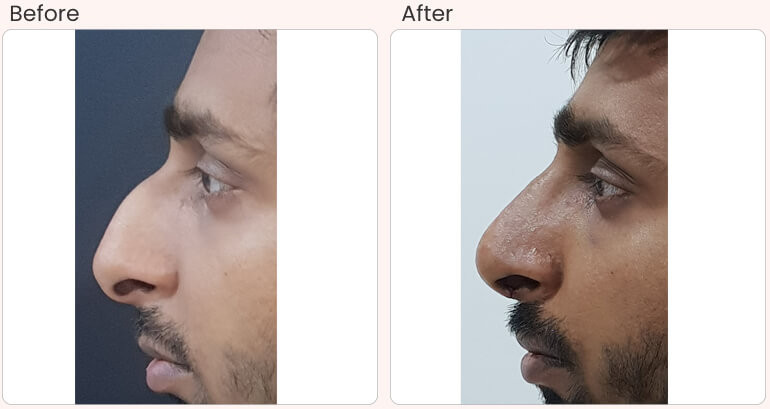 Beat Rhinoplasty Surgery in Delhi - Dr Rajat Gupta