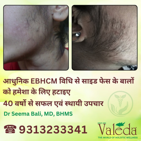 permanent-treatment-for-unwanted-hair-valeda-ebhcm