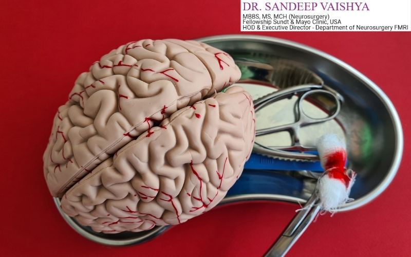 Deep Brain Stimulation Surgery in India