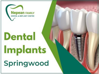 Smile Confidently with Dental Implants in Springwood | Nepean Family Dental