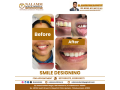 dental-clinics-in-kumbakonam-nalamm-dental-hospital-small-4