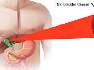 Expert Gallbladder Cancer Treatment in Ludhiana