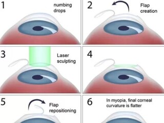 LASIK Eye Surgery