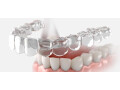 why-proper-teeth-alignment-is-essential-for-oral-health-small-0