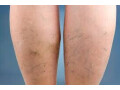 best-vein-surgeon-is-crucial-for-varicose-veins-management-small-0