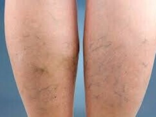 Best Vein Surgeon Is Crucial for Varicose Veins Management