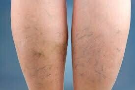 best-vein-surgeon-is-crucial-for-varicose-veins-management-big-0