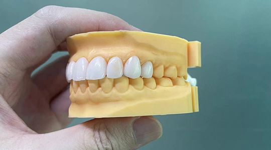 PFM Porcelain-Fused-to-Metal Crowns