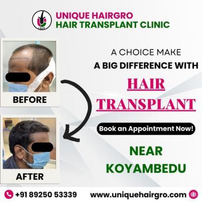 Hair transplant cost in chennai