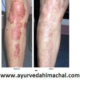 AROGYAM PURE HERBS KIT FOR PSORIASIS