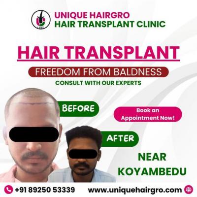 Best hair transplant doctors near me