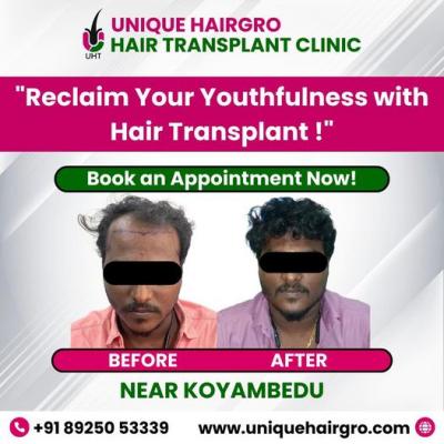 Best hair transplant clinic in tamilnadu