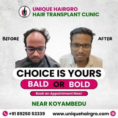 Best hair transplant clinic in tamilnadu