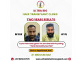 best-hair-care-clinic-chennai-small-2