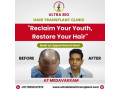 best-hair-transplant-clinic-in-tamilnadu-small-3