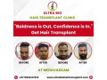 best-hair-transplant-clinic-in-tamilnadu-small-2