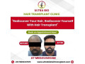 best-hair-transplant-clinic-in-tamilnadu-small-0