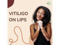 vitiligo-treatment-naturally-treatment-for-white-spot-on-skin-by-homeopathy-small-0