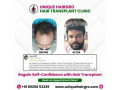 best-hair-transplant-doctors-near-me-small-2