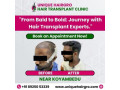 best-hair-transplant-clinic-in-tamilnadu-small-1