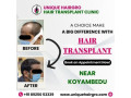 best-hair-transplant-clinic-in-tamilnadu-small-2