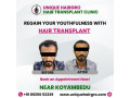 best-hair-transplant-clinic-in-tamilnadu-small-3