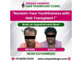 best-hair-transplant-clinic-in-tamilnadu-small-0