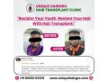 best-hair-transplant-clinic-in-tamilnadu-small-1