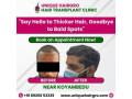 best-hair-care-clinic-chennai-small-0