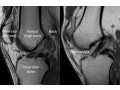 acl-injuries-london-small-0