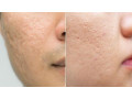 unlock-radiant-skin-derma-roller-treatment-at-skinpheras-gurgaon-small-0