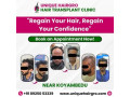 hair-transplant-cost-in-chennai-small-0