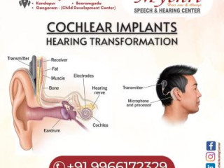 Cochlear Implants | Cochlear Implants Assessment | Cochlear Implant Surgery in Hyderabad