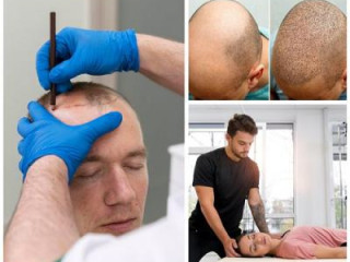 Achieve Inner and Outer Transformation with Hair Transplant and Somatic Therapy