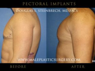 Transform Your Physique with Pec Implants