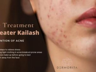 Acne Treatment in Greater Kailash