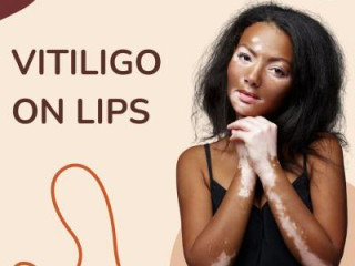 Vitiligo Treatment Naturally: Treatment for White Spot on Skin by Homeopathy