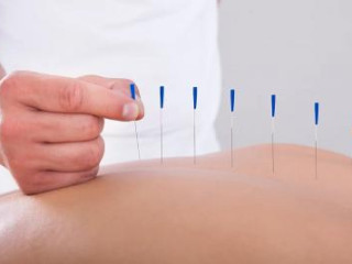 Dry Needling NYC