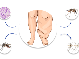 Filariasis : Effective Management | KBK Hospitals