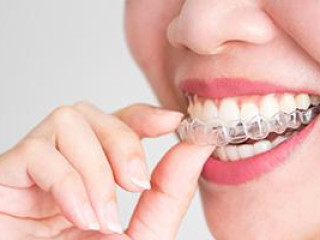 Best Invisalign Aligners in Hyderabad for Your Smile Transformation