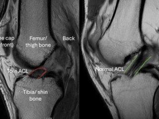 ACL Injuries London