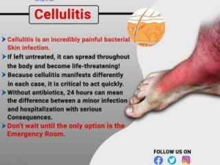 Cellulitis Treatment in Hyderabad