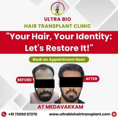 best-hair-transplant-clinic-in-tamilnadu-big-1