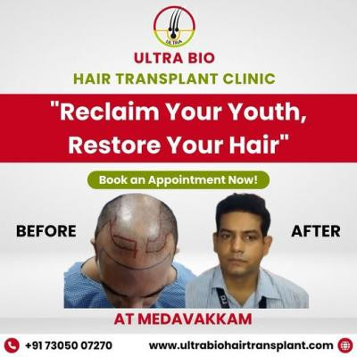 best-hair-transplant-clinic-in-tamilnadu-big-3