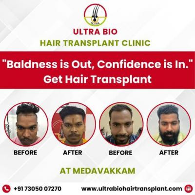 best-hair-transplant-clinic-in-tamilnadu-big-2