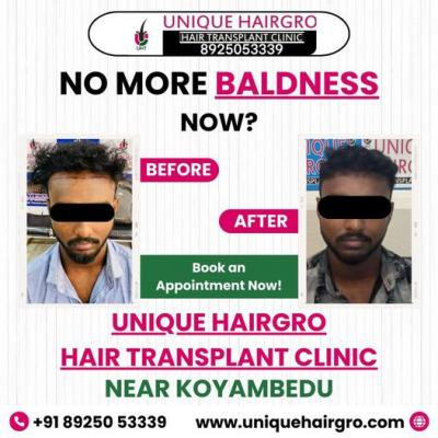 hair-transplant-cost-in-chennai-big-3