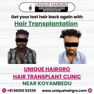 hair-transplant-cost-in-chennai-big-2