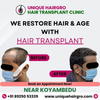 hair-transplant-cost-in-chennai-big-0